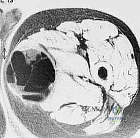 المتابعة الدورية للجرح بعد الخزعة