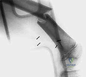 صورة توضيحية لـ فهم خزعة أورام الجهاز العضلي الهيكلي: دليل شامل للمرضى مع الأستاذ الدكتور محمد هطيف