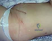 مناقشة تقرير الباثولوجي مع المريض