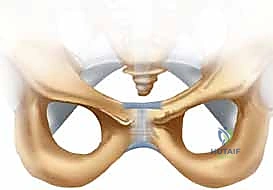 كسور الحلقة الحوضية الأمامية