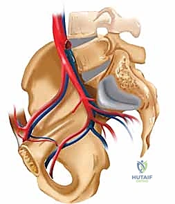 أعراض كسور الحوض