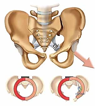 إغلاق الجرح الجراحي في عملية الحوض