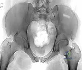 خطوات عملية تثبيت المفصل العاني