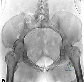 الخيارات العلاجية لكسور الحوض