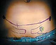 تثبيت المفصل العاني المفتوح: استعادة استقرار الحوض مع الأستاذ الدكتور محمد هطيف في صنعاء