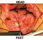 صورة توضيحية لـ تثبيت المفصل العاني المفتوح: استعادة استقرار الحوض