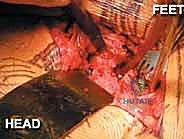 أسباب انفصال الارتفاق العاني