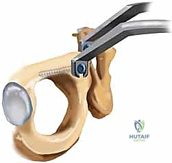 صورة توضيحية لـ تثبيت المفصل العاني المفتوح: استعادة استقرار الحوض مع الأستاذ الدكتور محمد هطيف في صنعاء