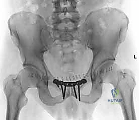 صورة توضيحية لـ تثبيت المفصل العاني المفتوح: استعادة استقرار الحوض مع الأستاذ الدكتور محمد هطيف في صنعاء