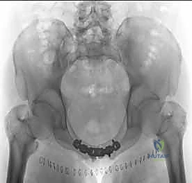 صورة توضيحية لـ تثبيت المفصل العاني المفتوح: استعادة استقرار الحوض مع الأستاذ الدكتور محمد هطيف في صنعاء