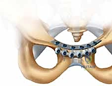 صورة طبية: تثبيت المفصل العاني المفتوح: استعادة استقرار الحوض مع الأستاذ الدكتور محمد هطيف في صنعاء