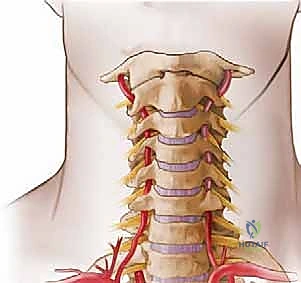 صورة توضيحية لـ تخفيف الضغط الخلفي ودمج الفقرات العنقية: دليل المريض الشامل مع الأستاذ الدكتور محمد هطيف في صنعاء