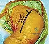 Illustration of pearls and pitfalls - Dr. Mohammed Hutaif