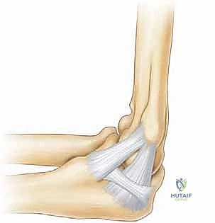 Illustration of valgus extension overload - Dr. Mohammed Hutaif