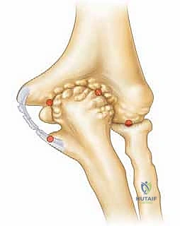 صورة توضيحية لخيارات العلاج التحفظي والتقييم الإشعاعي