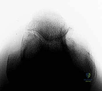 صورة توضيحية للنحت الدقيق للعظام واستعادة مساحة المفصل