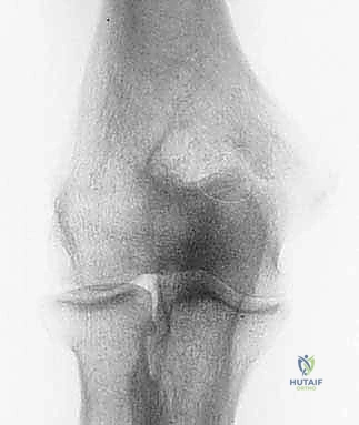 صورة توضيحية لعملية إزالة النتوءات العظمية بالمنظار - الخطوة الأولى