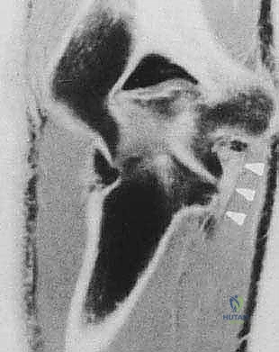 صورة توضيحية لـ إدارة متلازمة إجهاد الكوع الانقلابي بالمنظار خبرة الأستاذ الدكتور محمد هطيف في صنعاء