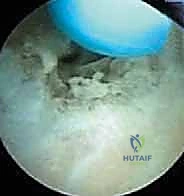 إدارة متلازمة إجهاد الكوع الانقلابي بالمنظار خبرة الأستاذ الدكتور محمد هطيف في صنعاء