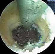 صورة توضيحية لـ إدارة متلازمة إجهاد الكوع الانقلابي بالمنظار خبرة الأستاذ الدكتور محمد هطيف في صنعاء