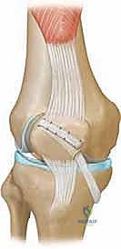 Intraoperative Surgical Step