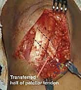 Surgical technique step for Patellar Instability