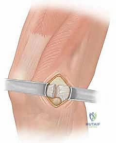 MPFL Repair & Reconstruction: A Masterclass in Patellar Instability Surgery