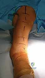 Illustration of fixation of humeral - Dr. Mohammed Hutaif