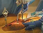 Navigated Total Knee Arthroplasty: An Intraoperative Masterclass