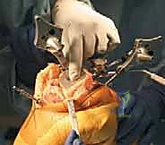 TECH FIG 8 Horseshoe cutting guide is fixed on the proximal tibia