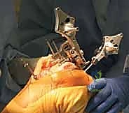 TECH FIG 8 Horseshoe cutting guide is fixed on the proximal tibia