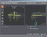 TECH FIG 8 Horseshoe cutting guide is fixed on the proximal tibia