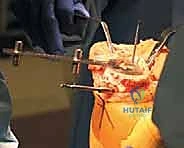 TECH FIG 10 The space for the tibial component keel is prepared using a power burr A and impactor B