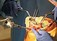 TECH FIG 8 Horseshoe cutting guide is fixed on the proximal tibia