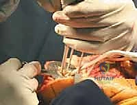 TECH FIG 10 The space for the tibial component keel is prepared using a power burr A and impactor B