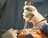 TECH FIG 10 The space for the tibial component keel is prepared using a power burr A and impactor B