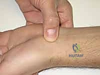 صورة أشعة سينية توضح عدم التحام العظم الزورقي