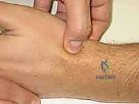 صورة توضح عدم التحام العظم الزورقي وتكون التكيسات