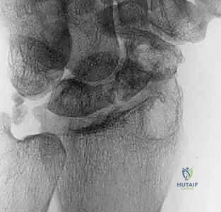 تحديد الشريان المغذي أثناء الجراحة الميكروسكوبية