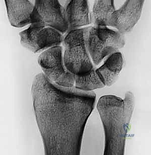 مقارنة بين الطعم العظمي العادي والوعائي