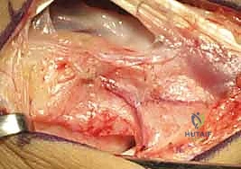 صورة توضيحية لـ ترقيع العظم الوعائي الظهري لعلاج عدم التحام العظم الزورقي: دليل شامل من الأستاذ الدكتور محمد هطيف في صنعاء