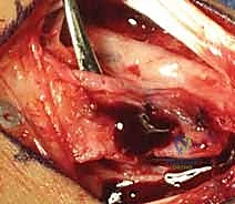 صورة توضيحية لـ ترقيع العظم الوعائي الظهري لعلاج عدم التحام العظم الزورقي: دليل شامل من الأستاذ الدكتور محمد هطيف في صنعاء