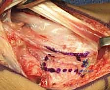 صورة توضيحية لـ ترقيع العظم الوعائي الظهري لعلاج عدم التحام العظم الزورقي: دليل شامل من الأستاذ الدكتور محمد هطيف في صنعاء