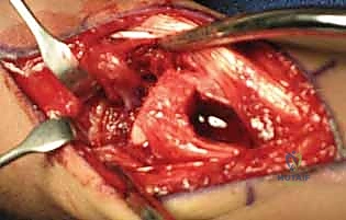 ترقيع العظم الوعائي الظهري لعلاج عدم التحام العظم الزورقي: دليل شامل من الأستاذ الدكتور محمد هطيف في صنعاء