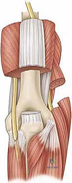 صورة توضيحية لـ تحرير تيبس المرفق بالمنظار: استعادة الحركة والحياة الطبيعية مع الأستاذ الدكتور محمد هطيف
