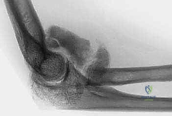 تحرير المحفظة الأمامية للمرفق