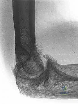 صورة توضيحية لـ تحرير تيبس المرفق بالمنظار: استعادة الحركة والحياة الطبيعية مع الأستاذ الدكتور محمد هطيف