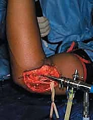 التأكد من المدى الحركي بعد التحرير