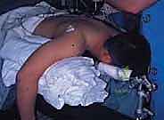 صورة توضيحية لـ تحرير تيبس المرفق بالمنظار: استعادة الحركة والحياة الطبيعية مع الأستاذ الدكتور محمد هطيف