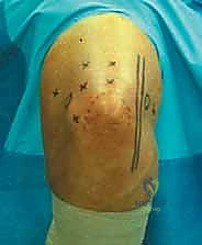 صورة توضيحية لـ تحرير تيبس المرفق بالمنظار: استعادة الحركة والحياة الطبيعية مع الأستاذ الدكتور محمد هطيف